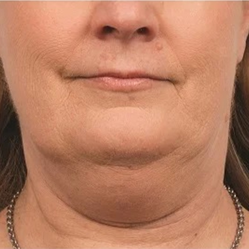Third patient before treatment, front-facing portrait