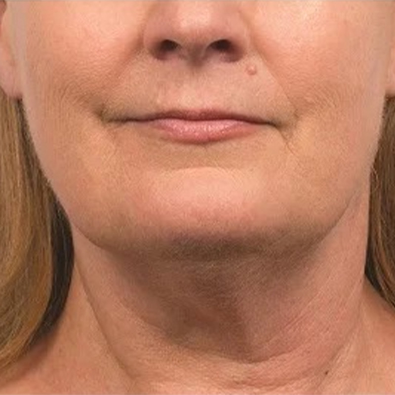 Third patient after treatment, front-facing portrait