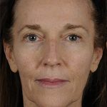 Fillers Before & After Patient #1825