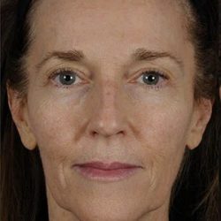Fillers Before & After Patient #1825