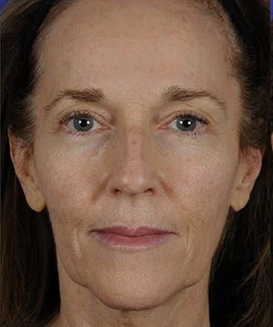 Fillers Before & After Patient #1825