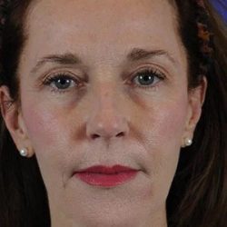 Fillers Before & After Patient #1825
