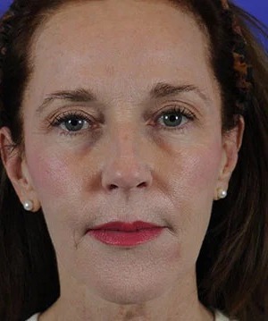 Fillers Before & After Patient #1825