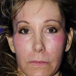Fillers Before & After Patient #1823
