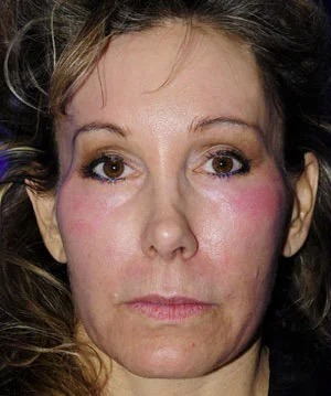 Fillers Before & After Patient #1823