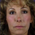 Fillers Before & After Patient #1823