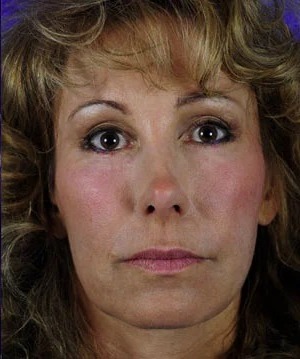 Fillers Before & After Patient #1823