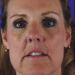 Fillers Before & After Patient #1822