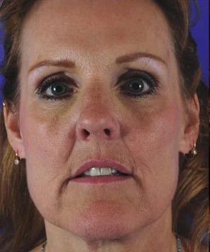 Fillers Before & After Patient #1822