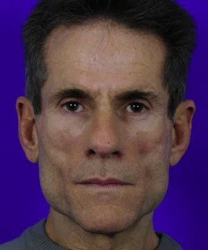Fillers Before & After Patient #1824