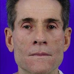 Fillers Before & After Patient #1824