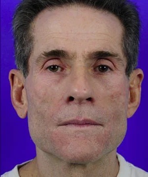 Fillers Before & After Patient #1824