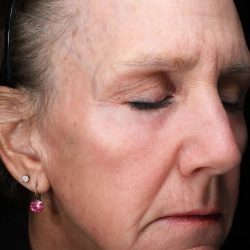 Fractional Laser Before & After Patient #1837