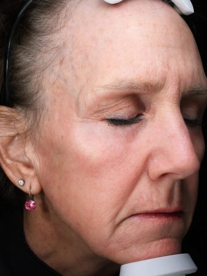 Fractional Laser Before & After Patient #1837