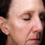 Fractional Laser Before & After Patient #1837