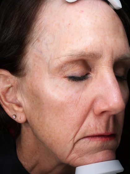 Fractional Laser Before & After Patient #1837