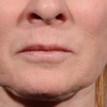 Morpheus8 Before & After Patient #1787