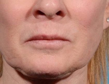 Morpheus8 Before & After Patient #1787