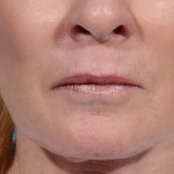 Morpheus8 Before & After Patient #1787