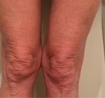 Morpheus8 Before & After Patient #1771