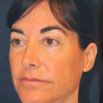 Fractional Laser Before & After Patient #1858