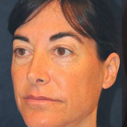 Fractional Laser Before & After Patient #1858
