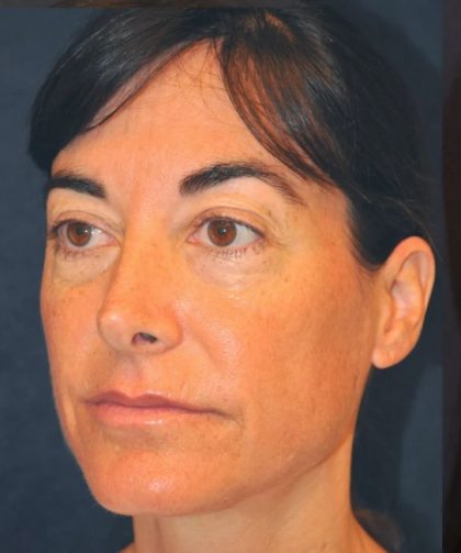 Fractional Laser Before & After Patient #1858