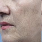 Fractional Laser Before & After Patient #1859
