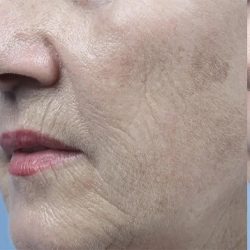 Fractional Laser Before & After Patient #1859