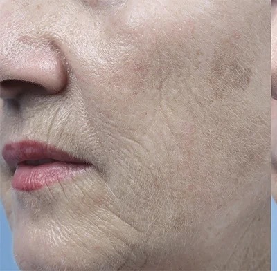 Fractional Laser Before & After Patient #1859