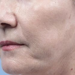 Fractional Laser Before & After Patient #1859