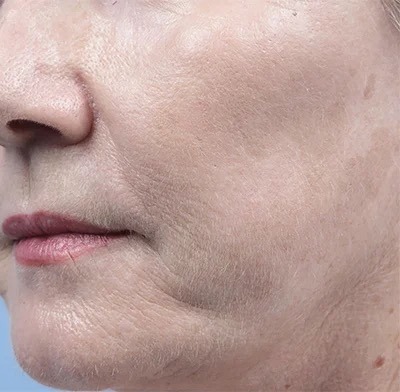 Fractional Laser Before & After Patient #1859