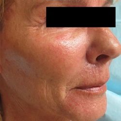 Fractional Laser Before & After Patient #1860