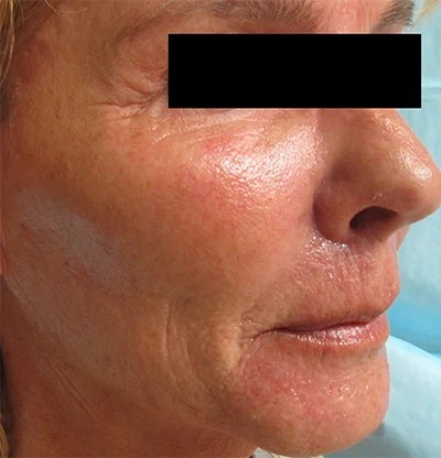 Fractional Laser Before & After Patient #1860