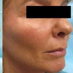Fractional Laser Before & After Patient #1860