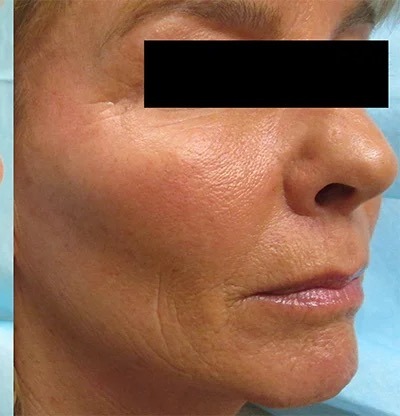 Fractional Laser Before & After Patient #1860