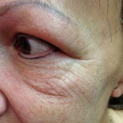 Fractional Laser Before & After Patient #1861