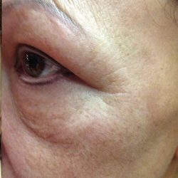 Fractional Laser Before & After Patient #1861