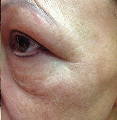 Fractional Laser Before & After Patient #1861