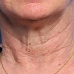 Fractional Laser Before & After Patient #1862