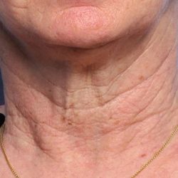 Fractional Laser Before & After Patient #1862