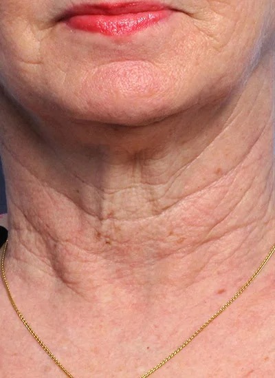Fractional Laser Before & After Patient #1862