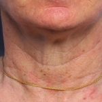 Fractional Laser Before & After Patient #1862