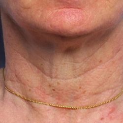 Fractional Laser Before & After Patient #1862