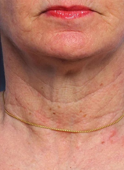 Fractional Laser Before & After Patient #1862