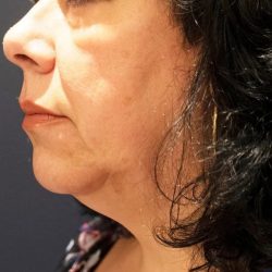 Morpheus8 Before & After Patient #1788