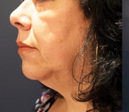 Morpheus8 Before & After Patient #1788