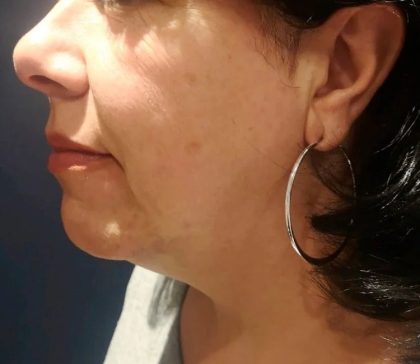 Morpheus8 Before & After Patient #1788