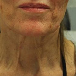 Morpheus8 Before & After Patient #1786