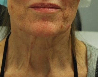 Morpheus8 Before & After Patient #1786
